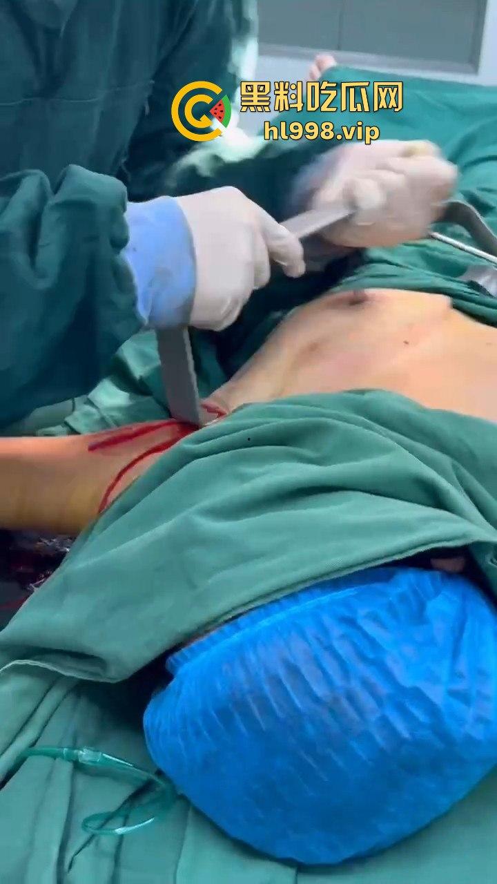 揭秘黄晓明女友『叶柯』同款隆胸术手术过程,看的让人心惊!胸被医生猛戳猛捣,视觉冲击强到不敢看!-13