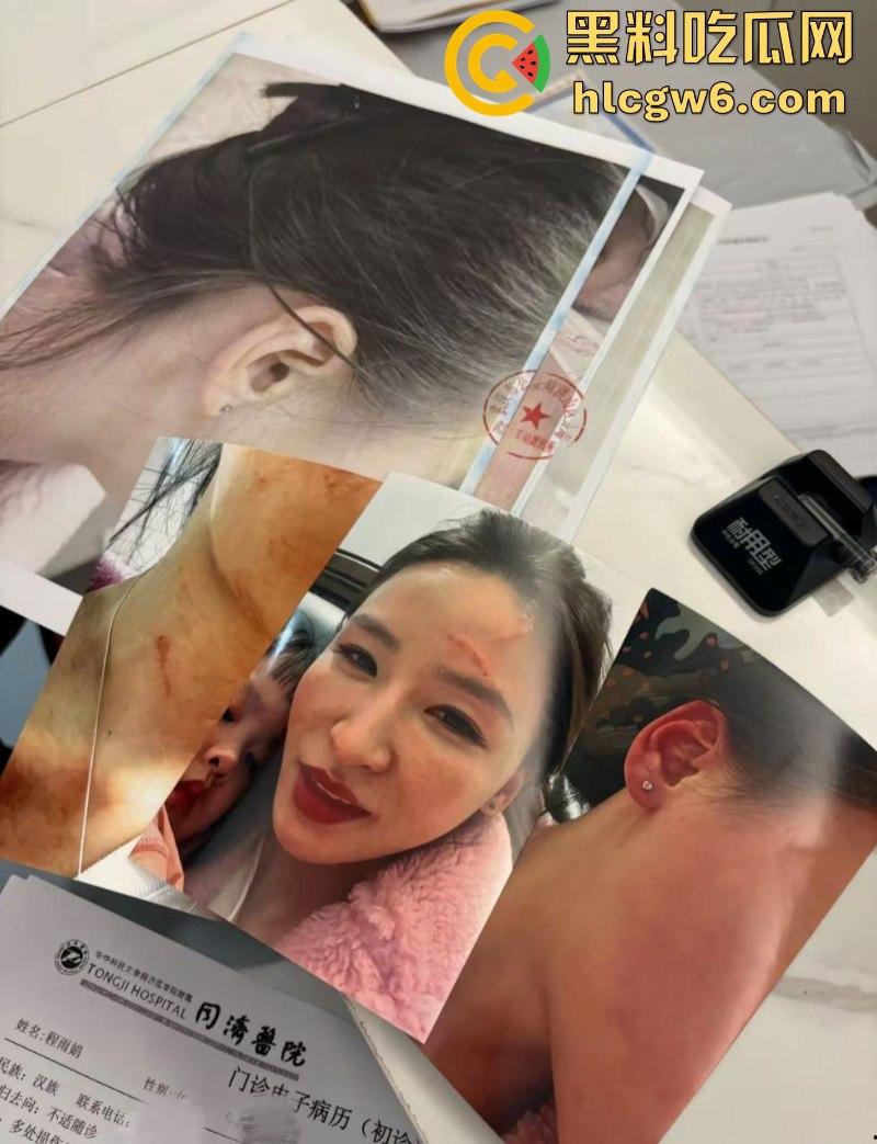 湖北一小学美女老师抖音自曝离婚探女遭前夫爹殴打抓脸全身多处受伤 伤情实拍曝光！都是血口子