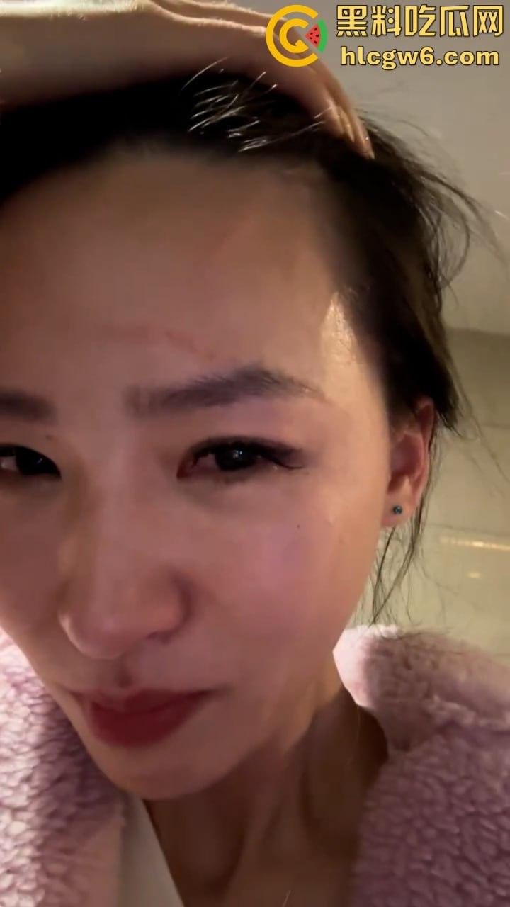 湖北一小学美女老师抖音自曝离婚探女遭前夫爹殴打抓脸全身多处受伤 伤情实拍曝光!都是血口子-8