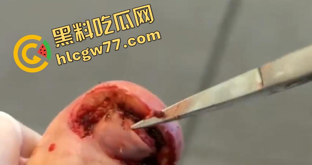 患者天天啃脚指甲狂得甲沟炎！帕尔米耶里手术刀下血肉狂飙，操刀医生差点呕吐！-4