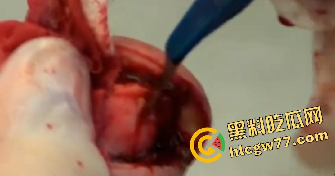 患者天天啃脚指甲狂得甲沟炎！帕尔米耶里手术刀下血肉狂飙，操刀医生差点呕吐！-6