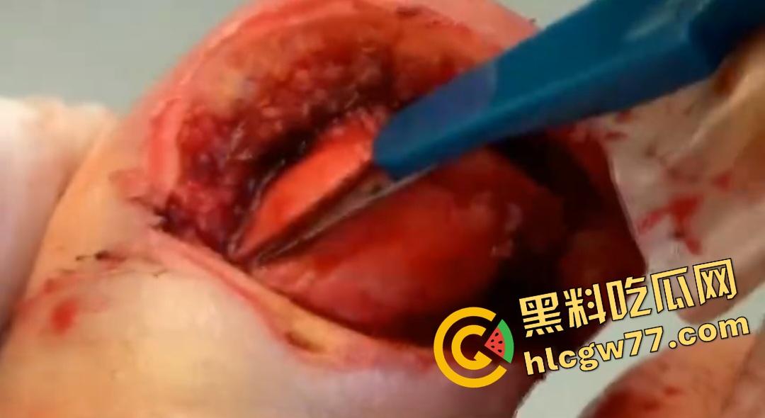 患者天天啃脚指甲狂得甲沟炎！帕尔米耶里手术刀下血肉狂飙，操刀医生差点呕吐！-7