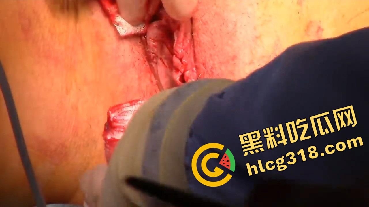 阴唇整形一刀逆天改命,黑木耳变粉鲍鱼,大阴唇手术直接打造一线天馒头逼,姑娘做完直接彩礼翻倍!-13